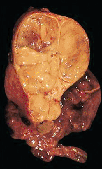 Image: An encapsulated thymoma (Photo courtesy of the [US] Armed Forces Institute of Pathology.